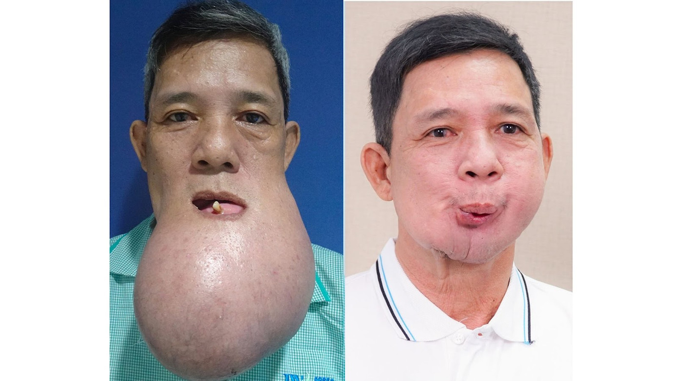 Ca mổ cắt bỏ khối u khổng lồ cho chú Khanh là một trong những ca phẫu thuật thách thức nhất