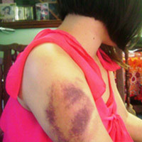 Hai cánh tay C. bị bầm tím nghi do cha hành hung