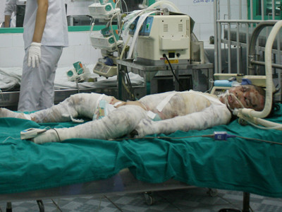 Bé Ngọc được cấp cứu tại BV và phải thở bằng ô-xy. Ảnh: Phạm Duẩn