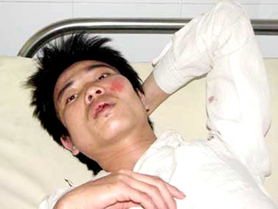 Một nạn nhân bị ông chủ đánh đập. Một nạn nhân bị ông chủ đánh đập