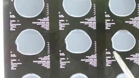 Hình ảnh X-Quang cho thấy vùng sọ của bé Tuấn Minh bị lõm