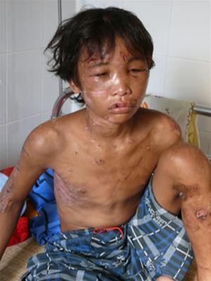 Nhiều vết thương trên người Hào Anh bị nhiễm trùng do bị đánh đập.