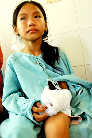 Cháu Phạm Thị Diễm Ngân đang điều trị tại khoa bỏng - bệnh viện đa khoa Đà Nẵng nức nở khi nhớ lại giây phút kinh hoàng