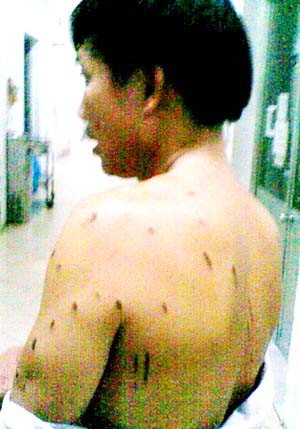 Ông Vũ Văn Tiến kể lại diễn biến đêm kinh hoàng (đêm 5/6) với những dấu tích do bị “dính” a xít trên lưng