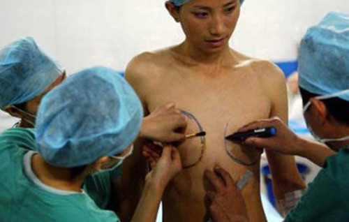 Giai đoạn 3 phẫu thuật thay đổi cơ quan sinh dục. Giai đoạn 3 phẫu thuật thay đổi cơ quan sinh dục