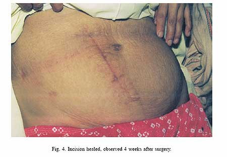 Bà mẹ tự mổ bụng moi con.. Bà mẹ tự mổ bụng moi con.