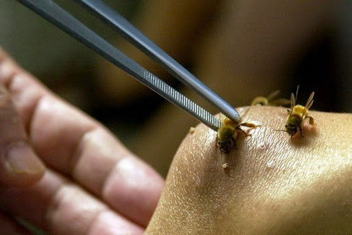 Vì sao bị ong vò vẽ đốt có thể tử vong sau 15 phút? ảnh 1