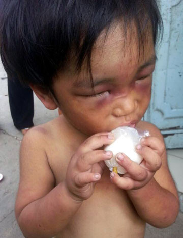 Cháu Đức lúc đi ăn xin ngoài đường, gương mặt còn đầy thương tích được người dân phát hiện. Ảnh: CTV