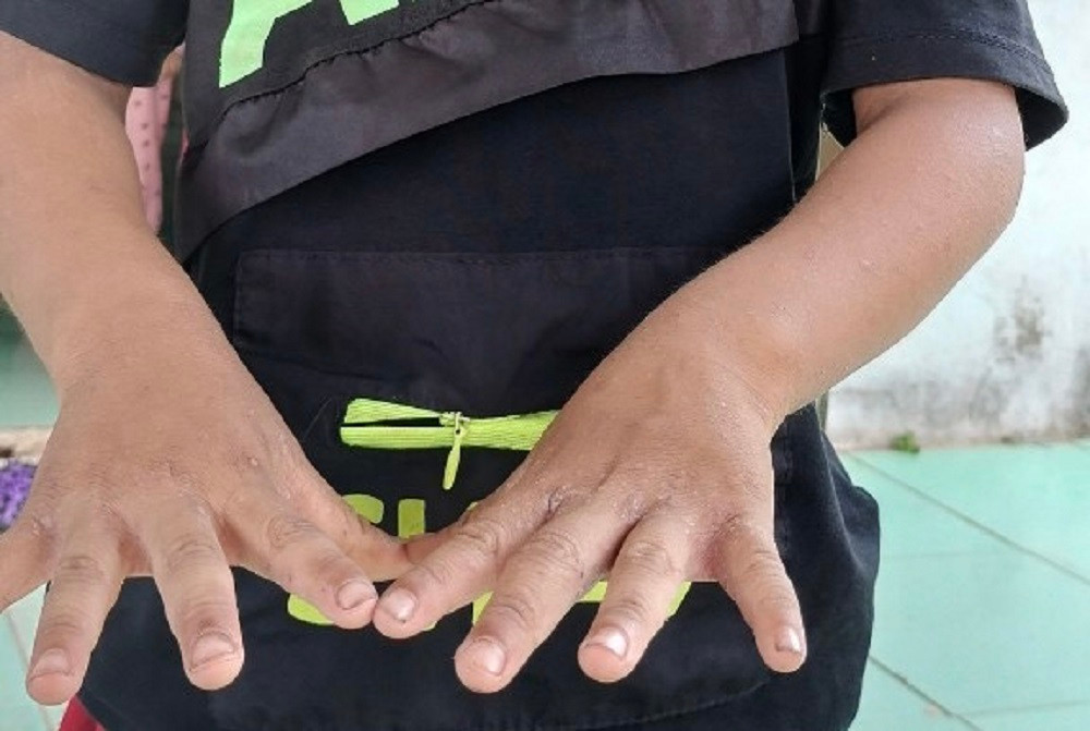 Nhiều trẻ em ở thôn Tang bị bệnh ghẻ.