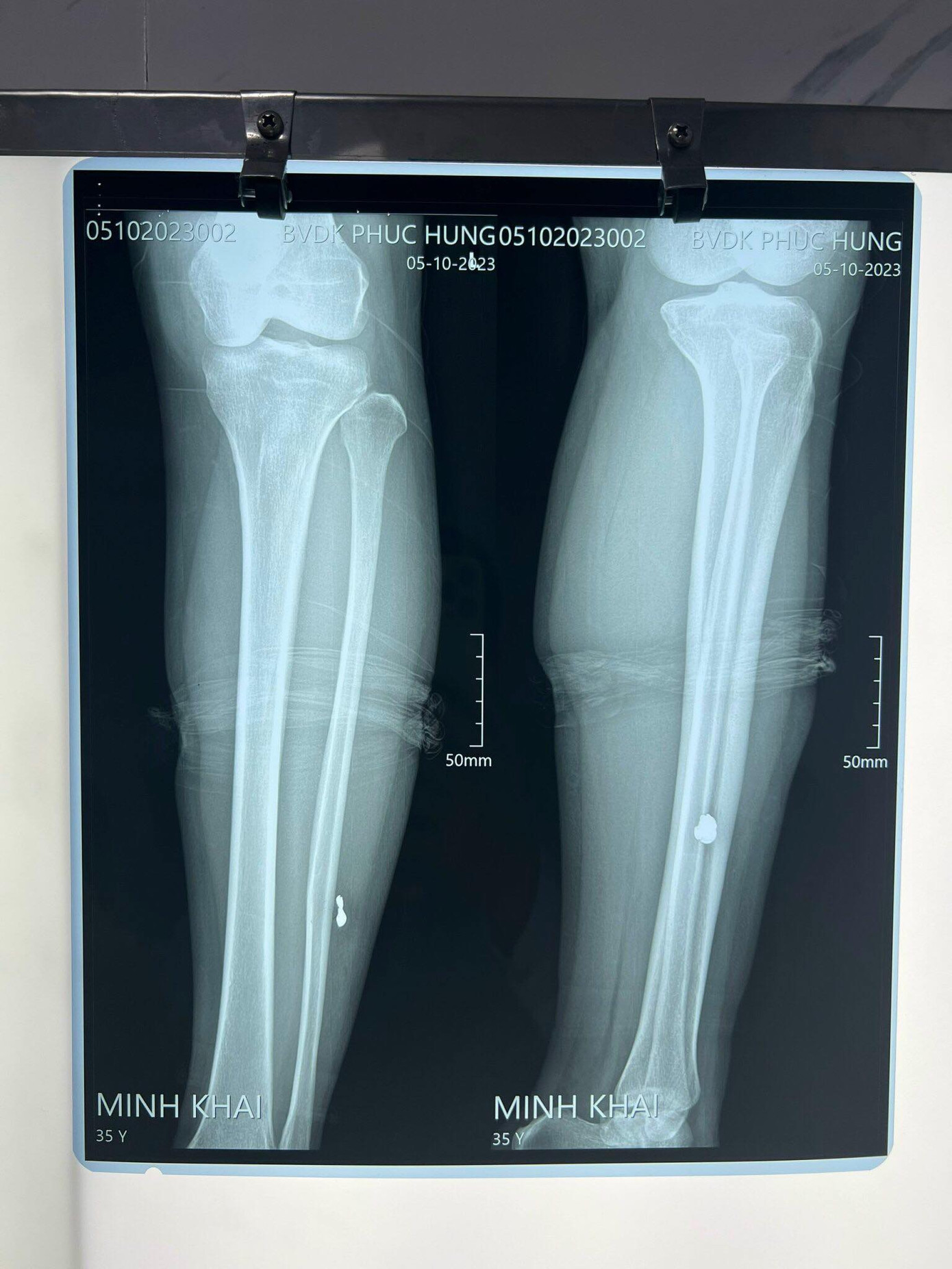 Hình ảnh chụp x quang của hai nữ lao công. Hình ảnh chụp x quang của hai nữ lao công.