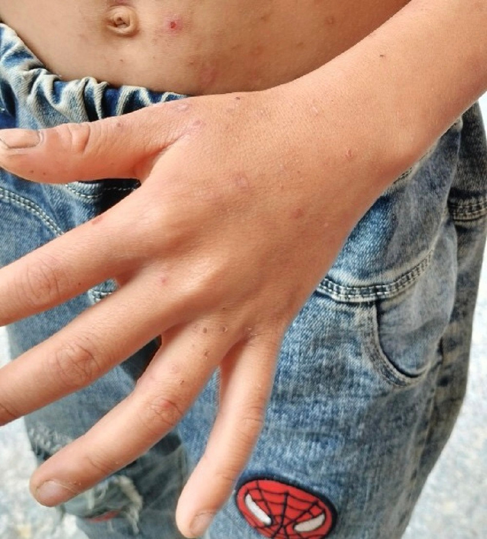 Ghẻ lở trên nhiều vị trí cơ thể,