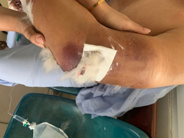 Shipper Lâm Anh Đạt bị người nhận hàng đánh gãy cả 2 tay. Shipper Lâm Anh Đạt bị người nhận hàng đánh gãy cả 2 tay.