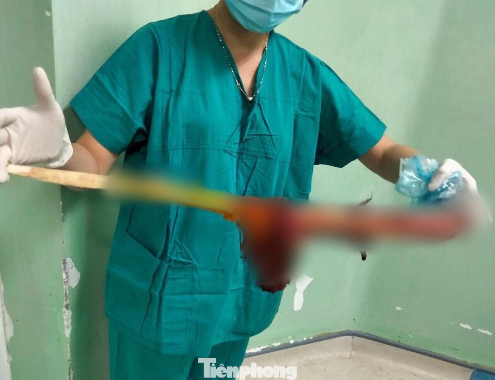 Khúc keo sau khi được lấy ra. Ảnh: (BVĐK)