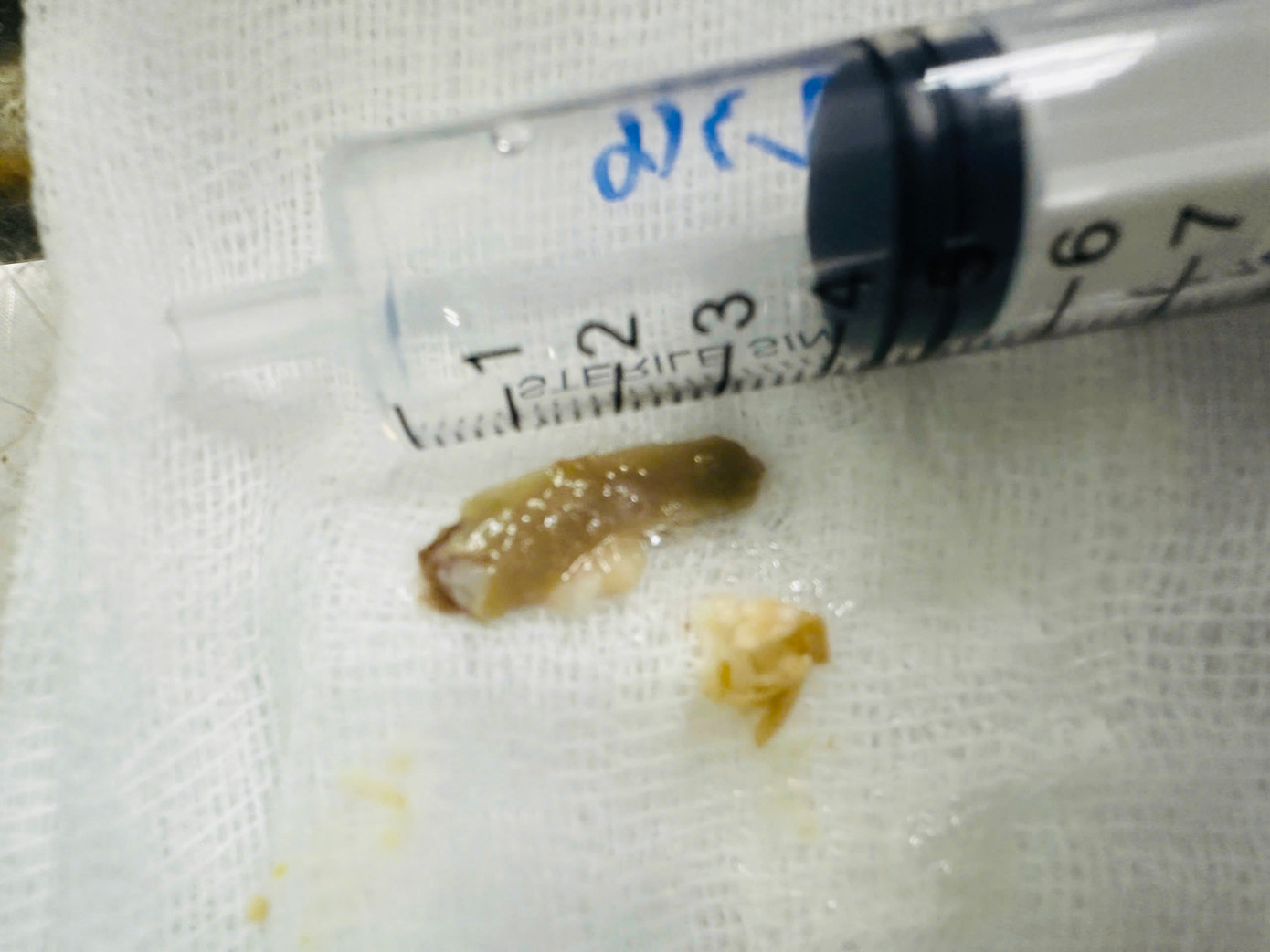 Đoạn xương gà dài khoảng 3cm vừa được gắp ra. Đoạn xương gà dài khoảng 3cm vừa được gắp ra.