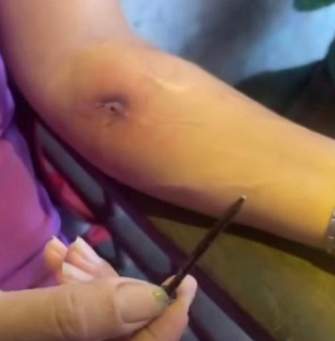 Clip người phụ nữ ở Quảng Ngãi rút đinh từ cánh tay lan truyền trên mạng xã hội. (Ảnh cắt từ video)