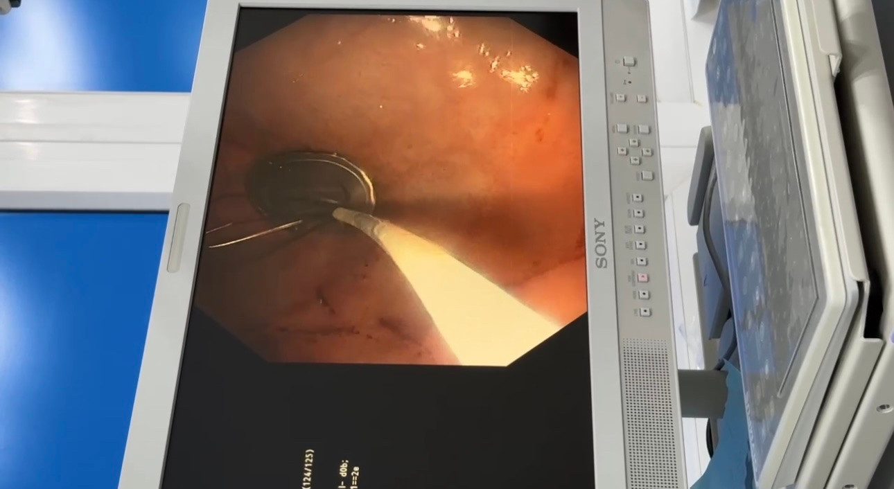 Hình ảnh nắp lon nước ngọt nằm trong dạ dày bệnh nhi. Hình ảnh nắp lon nước ngọt nằm trong dạ dày bệnh nhi.