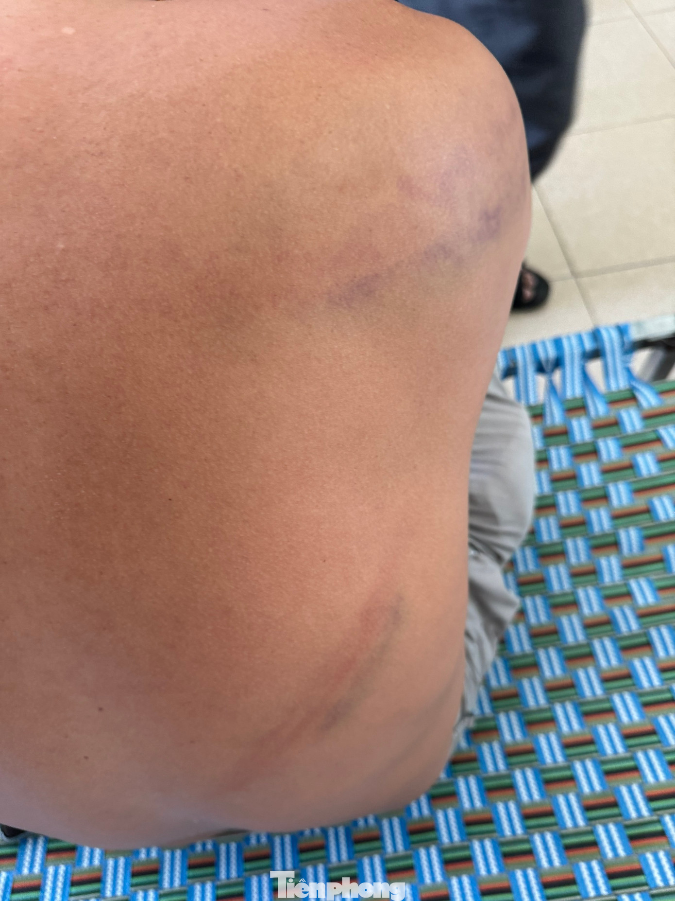 Thuyền trưởng Nguyễn Thanh Biên bị đánh đập với nhiều vết bầm tím trên người. Thuyền trưởng Nguyễn Thanh Biên bị đánh đập với nhiều vết bầm tím trên người.