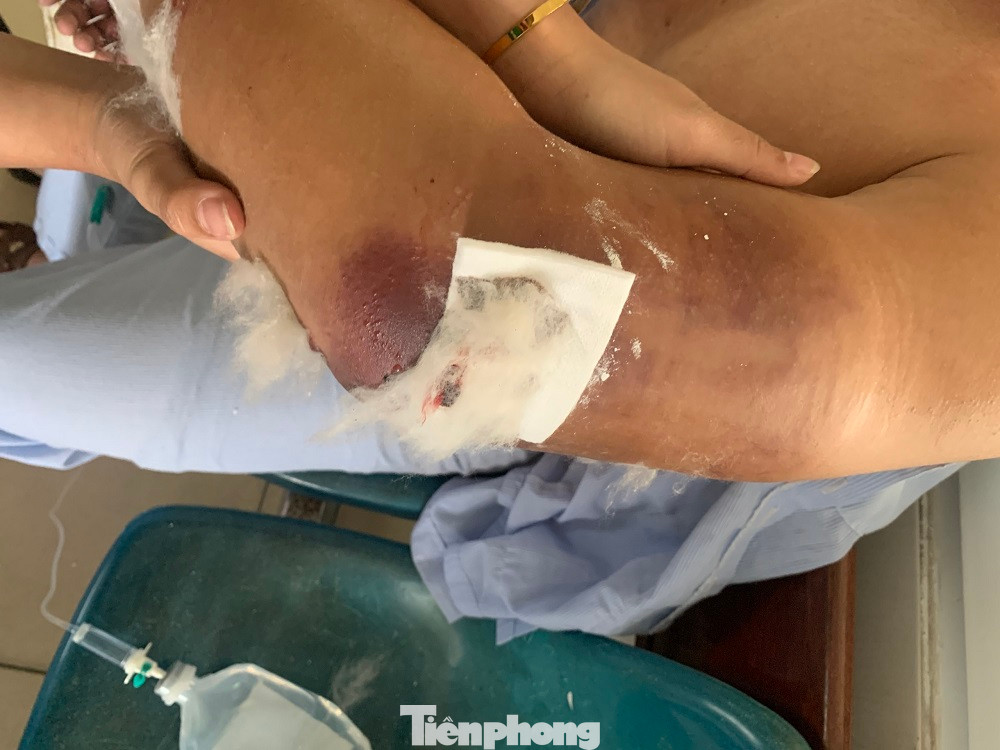 Cánh tay của shipper Đạt bầm tím. Cánh tay của shipper Đạt bầm tím.