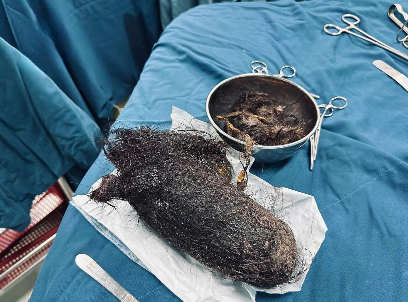 Búi tóc nặng gần 1kg được các bác sĩ phẫu thuật lấy ra từ dạ dày bệnh nhi 12 tuổi. Búi tóc nặng gần 1kg được các bác sĩ phẫu thuật lấy ra từ dạ dày bệnh nhi 12 tuổi.