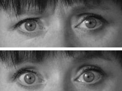 Đôi mắt trong trạng thái bình thường (ảnh trên) và khi bị thôi miên (ảnh dưới). Ảnh: Viện Hàn lâm Phần Lan