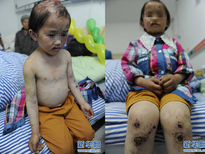 Xiaoli trụi tóc, người đầy sẹo vì bị hành hạ suốt 5 năm. Ảnh: Xinhuanet. Xiaoli trụi tóc, người đầy sẹo vì bị hành hạ suốt 5 năm. Ảnh: Xinhuanet