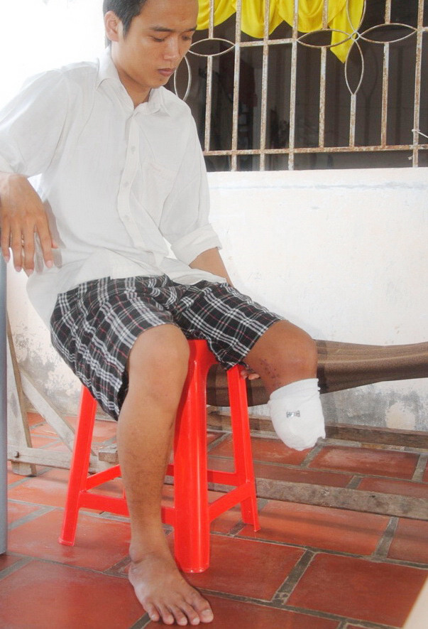 Nguyễn Hải Triều đau đớn với chân trái bị cưa gần tới gối. Nguyễn Hải Triều đau đớn với chân trái bị cưa gần tới gối