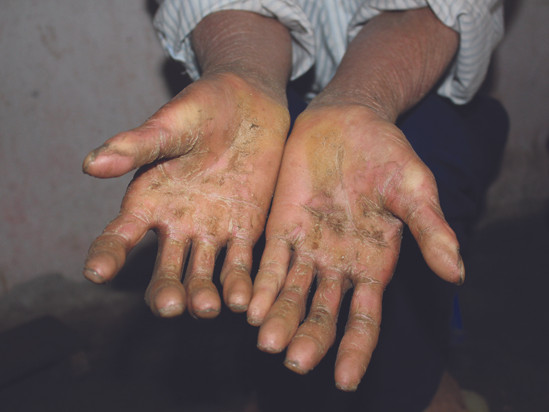 Bàn tay bị biến dị, nứt toác do căn bệnh tai ác. Ảnh: Lao Động
