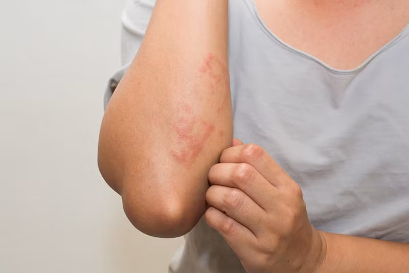 Theo BS Giang, biểu hiện thương tổn là các sẩn huyết thanh, kích thước 1-2mm, gờ cao hơn mặt da, đỉnh chóp sẩn có mụn nước nhỏ, rất ngứa. Những trường hợp phản ứng mạnh có thể thấy hiện tượng viêm tấy đỏ lan toả xung quanh sẩn. Thương tổn thường gặp chủ yếu ở phần da hở. Ảnh minh họa: Internet Theo BS Giang, biểu hiện thương tổn là các sẩn huyết thanh, kích thước 1-2mm, gờ cao hơn mặt da, đỉnh chóp sẩn có mụn nước nhỏ, rất ngứa. Những trường hợp phản ứng mạnh có thể thấy hiện tượng viêm tấy đỏ lan toả xung quanh sẩn. Thương tổn thường gặp chủ yếu ở phần da hở. Ảnh minh họa: Internet
