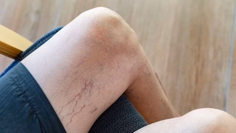 Nếu không được phát hiện và điều trị kịp thời, suy giãn tĩnh mạch có thể dẫn đến các biến chứng nghiêm trọng. Ảnh minh họa: Internet