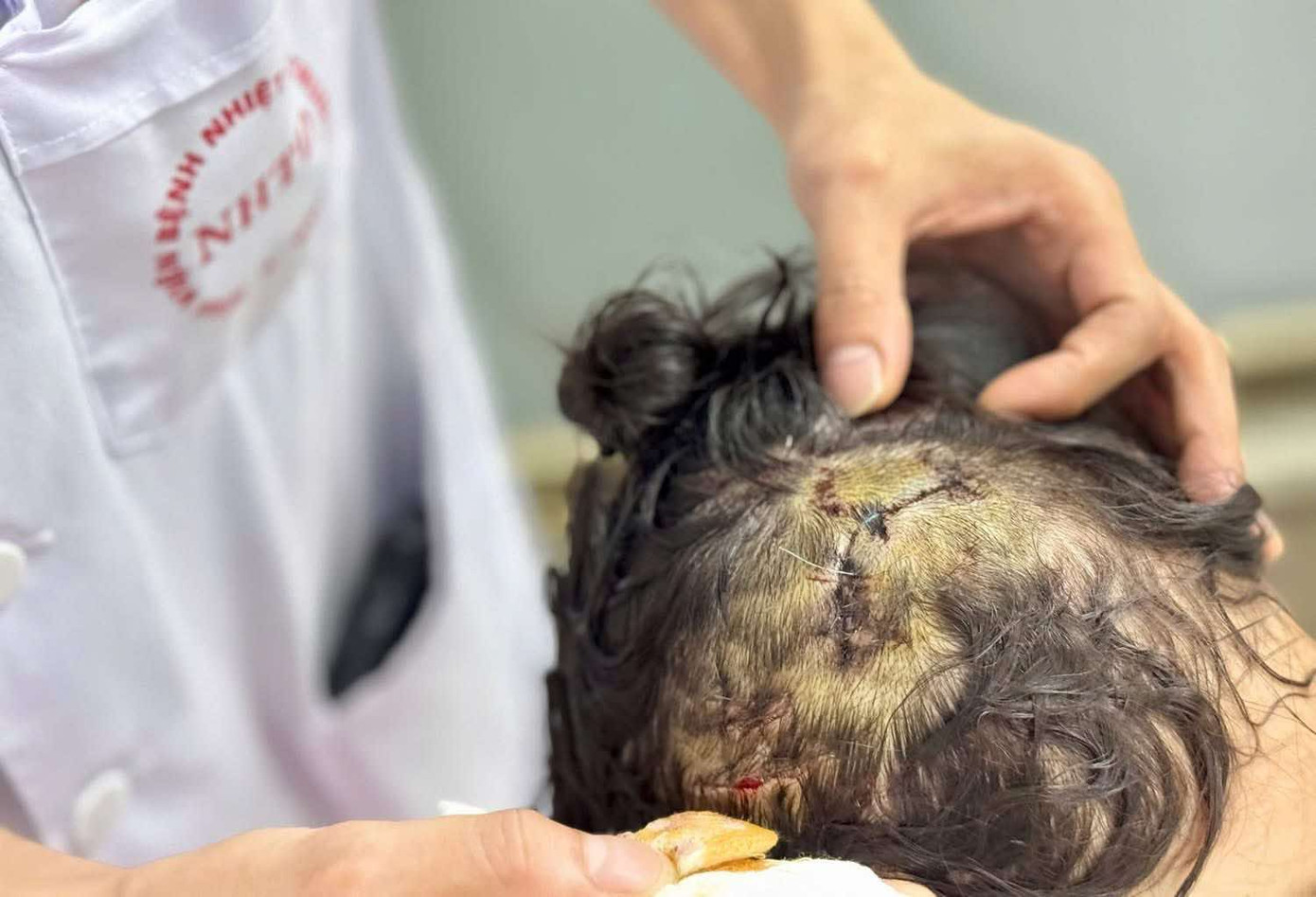 Vết thương lớn trên vùng đầu bé gái do chó nhà nuôi cắn. Ảnh: Bệnh viện Bệnh Nhiệt đới Trung ương