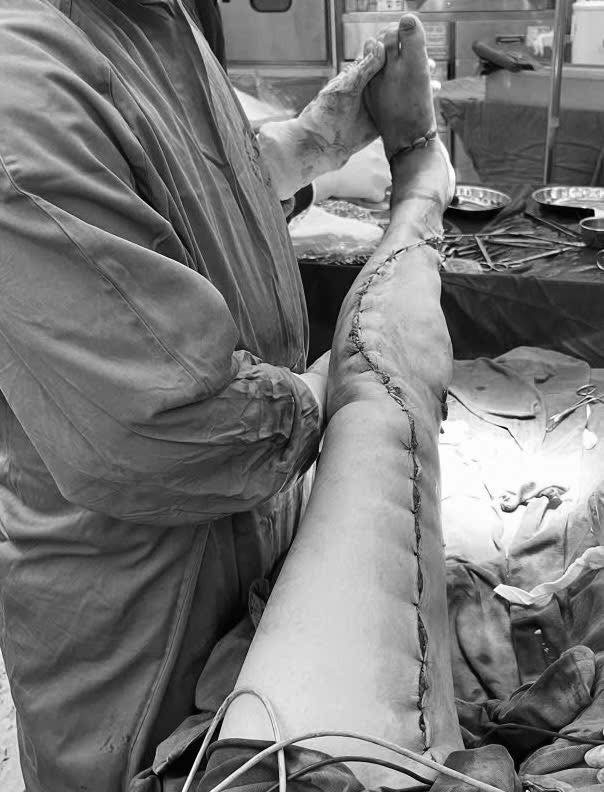 Không những được cứu sống, bệnh nhân còn được bảo tồn chân nhờ sự nỗ lực cấp cứu nhanh và chính xác tuyệt vời của các y bác sĩ. Ảnh: Bệnh viện Bệnh Nhiệt đới Trung ương