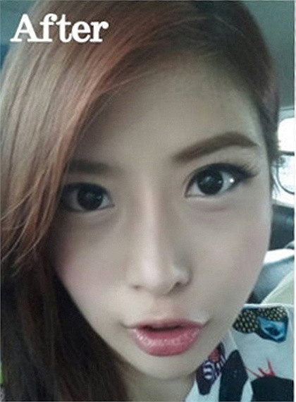 Hình ảnh Dora 30 ngày sau ca phẫu thuật, khuôn mặt của cô gần như thay đổi và góc cạnh hơn