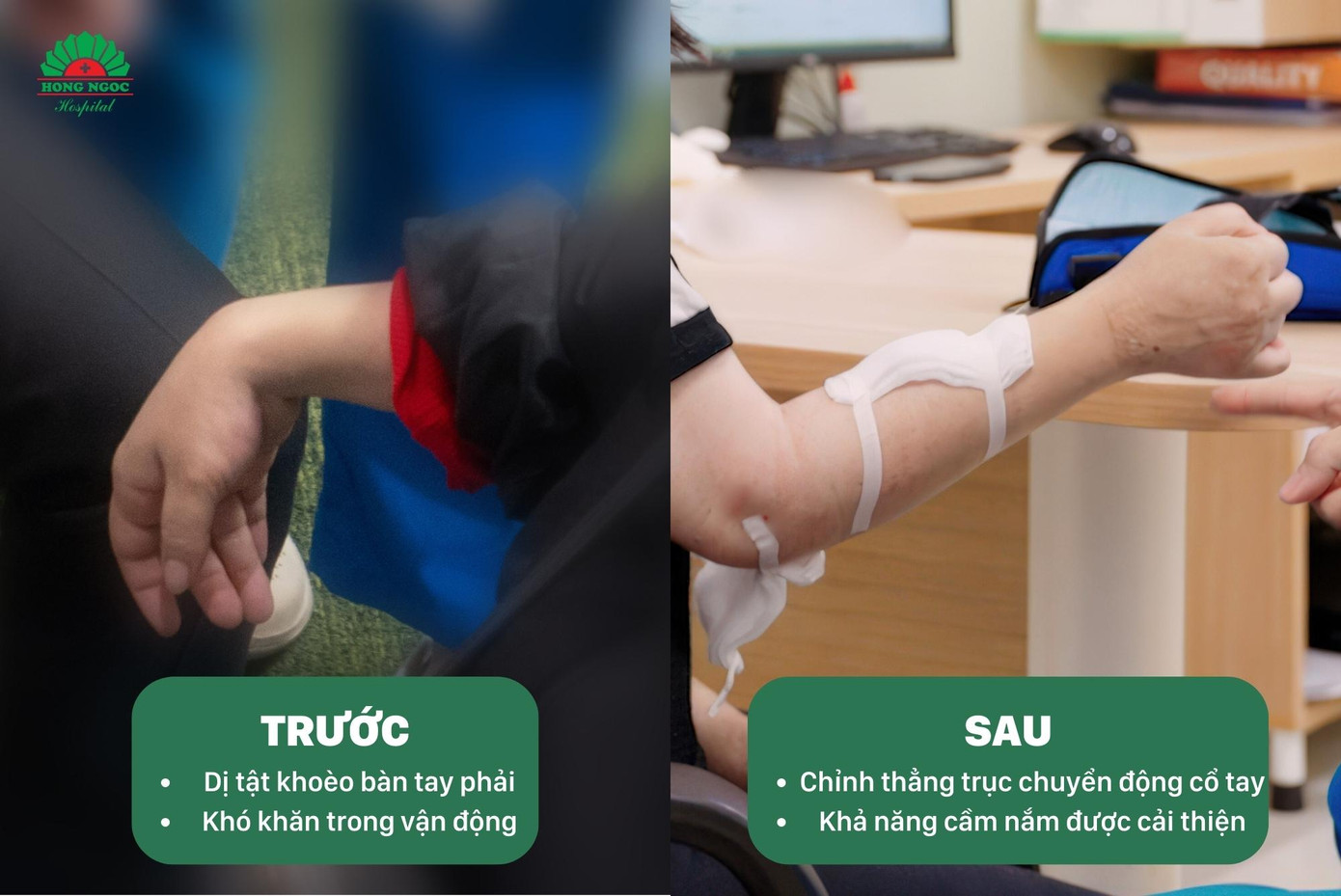 Bệnh nhân Trần Khánh Linh dị tật khoèo tay phải trước và sau phẫu thuật (đang trong quá trình phục hồi) Bệnh nhân Trần Khánh Linh dị tật khoèo tay phải trước và sau phẫu thuật (đang trong quá trình phục hồi)