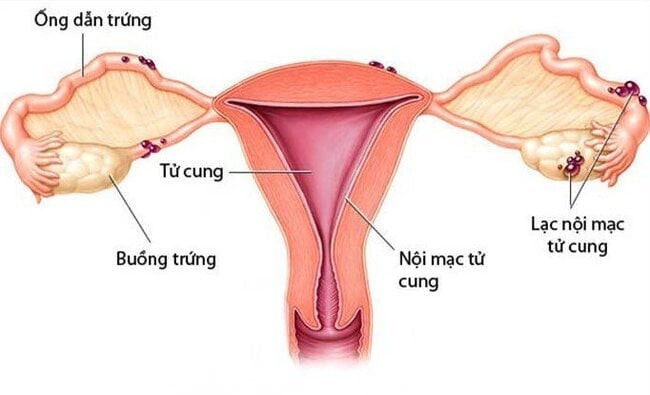 Tình trạng lạc nội mạc gây viêm nhiễm và khiến phụ nữ khó mang thai tự nhiên