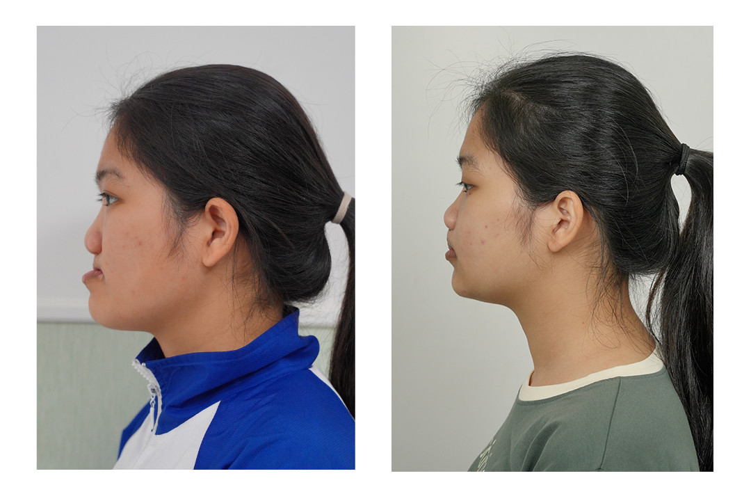 Hiền Hoà trước và sau phẫu thuật tại Bệnh viện Hồng Ngọc. Hiền Hoà trước và sau phẫu thuật tại Bệnh viện Hồng Ngọc.