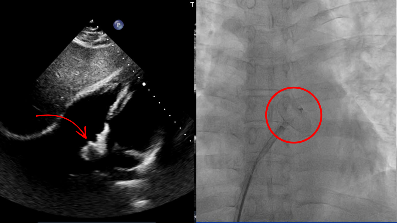 Lỗ thông liên nhĩ đã được bít dù của bệnh nhân Lâm Lỗ thông liên nhĩ đã được bít dù của bệnh nhân Lâm