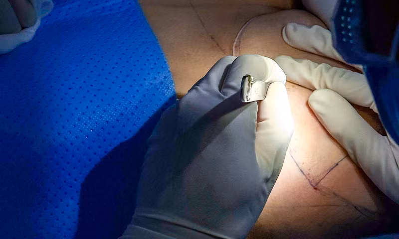 Cắt ngực bằng dao siêu âm: Có thật sự an toàn? ảnh 2