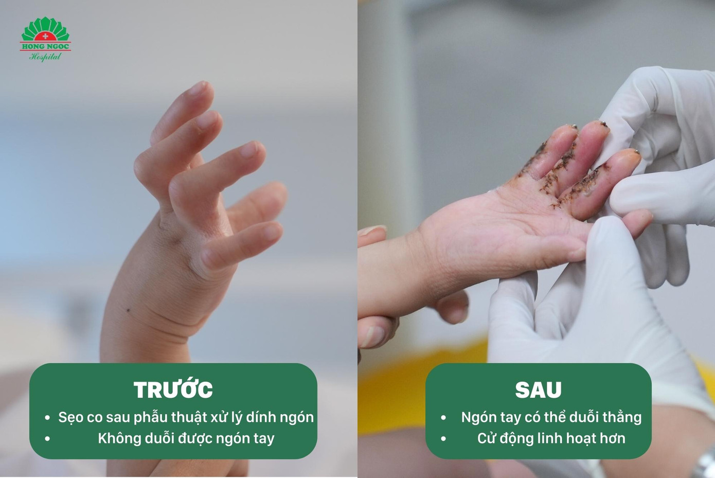 Bệnh nhân Lê Nguyễn Nhật Linh bị sẹo co tay phải trước và sau phẫu thuật (đang trong quá trình hồi phục) Bệnh nhân Lê Nguyễn Nhật Linh bị sẹo co tay phải trước và sau phẫu thuật (đang trong quá trình hồi phục)