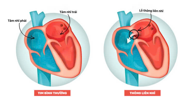 Hình ảnh tim bị thông liên nhĩ Hình ảnh tim bị thông liên nhĩ