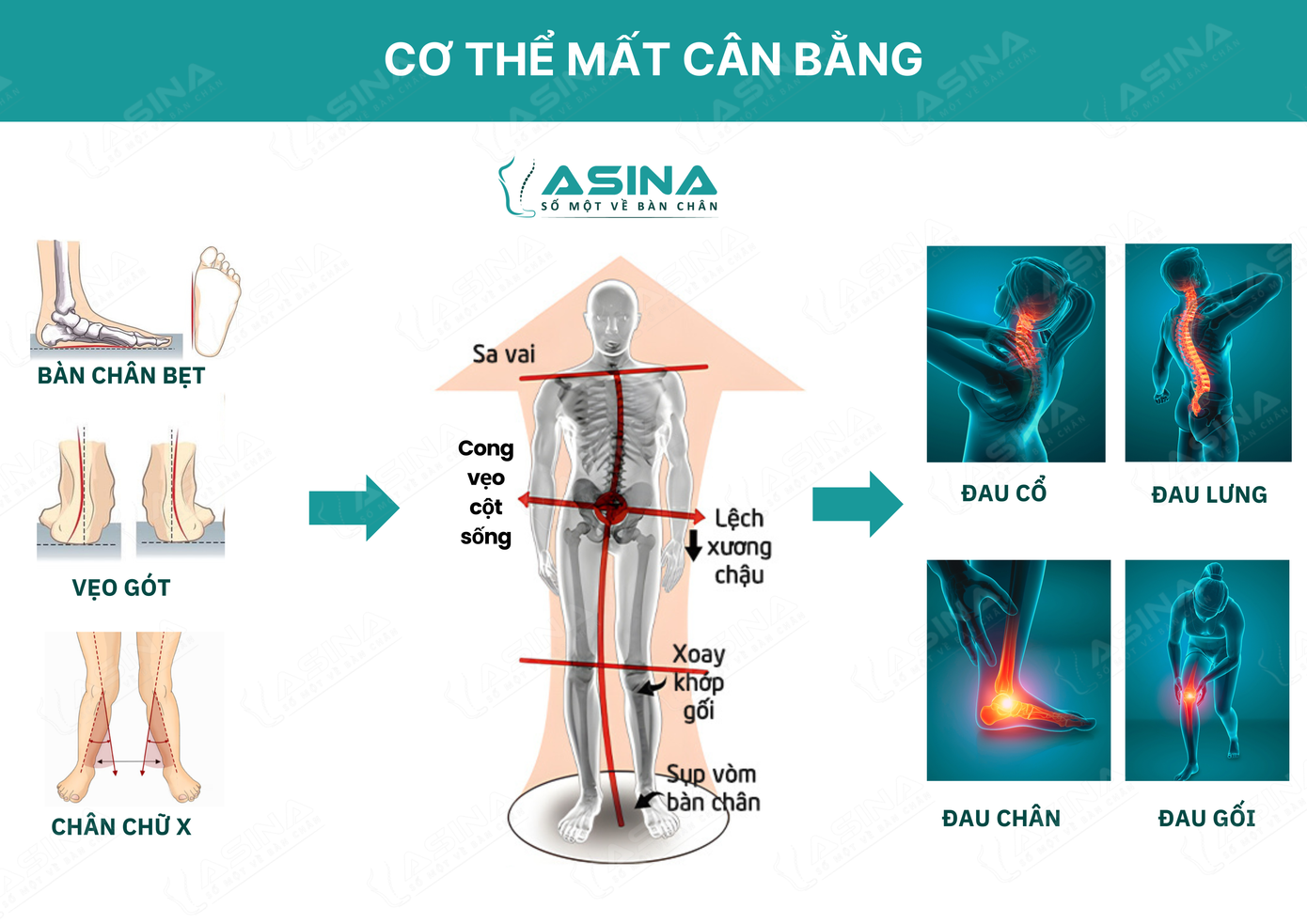 Dấu hiệu và hệ quả của bàn chân bẹt