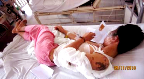 Nam sinh Lâm Thiên Phúc đang điều trị tại bệnh viện với những vết bỏng khắp cơ thể