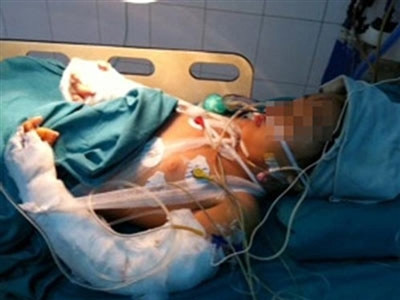 Sức khoẻ cháu Bích tiến triển tốt sau ca đại phẫu nối bàn tay bị bọn cướp chặt đứt. Ảnh: NLĐ