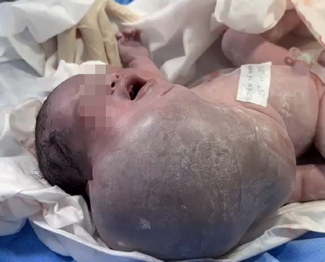 Khối bướu lớn trên vùng mặt, cổ, ngực khiến bệnh nhi nguy kịch ngay sau khi chào đời