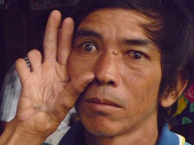 Đỗ Cảnh - một nạn nhân của mìn