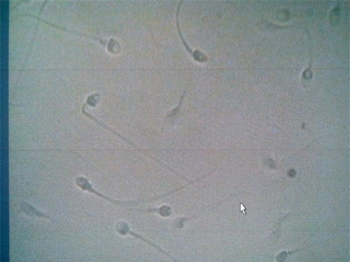  ...rất may tỷ lệ di động tinh trùng của Huy vẫn đạt 70%. Ảnh: Lê Phương. 