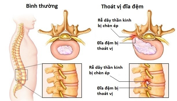 Giải pháp vàng từ bài thuốc Đông y cổ truyền điều trị thoát vị đĩa đệm ảnh 1