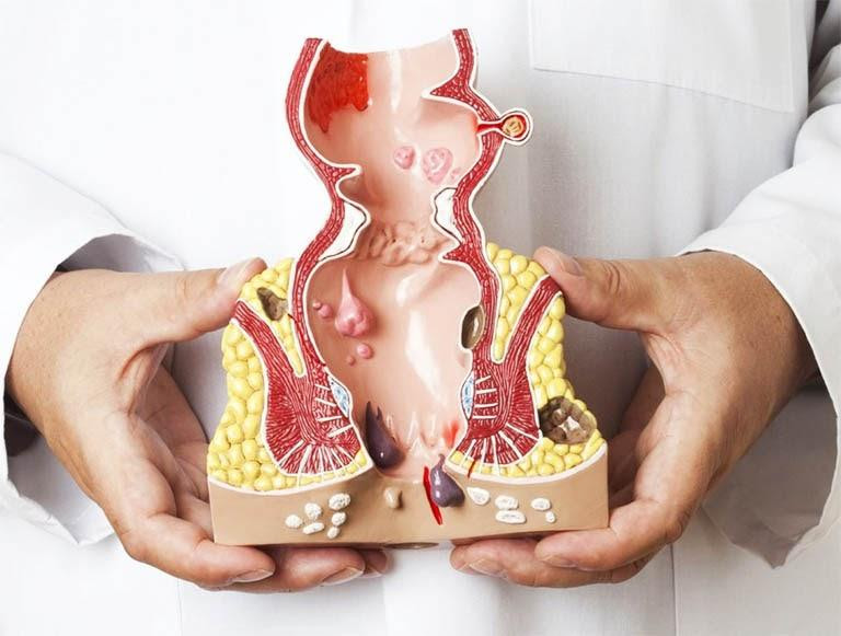 Bệnh trĩ tuy không ảnh hưởng đến tính mạng nhưng cần được điều trị kịp thời để tránh biến chứng nặng nề.