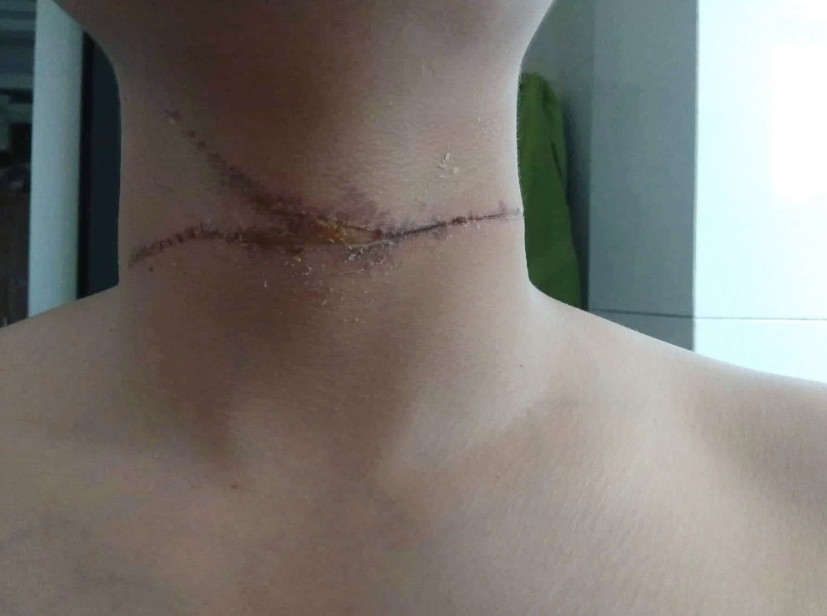 Dây diều rơi, siết mạnh vào cổ anh Đ. (Ảnh: Nhân vật cung cấp). Dây diều rơi, siết mạnh vào cổ anh Đ. (Ảnh: Nhân vật cung cấp).