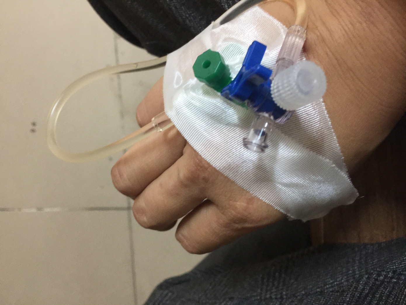 6 năm điều trị ung thư, chị Tuyền truyền hơn 100 mũi hóa chất và hóa chất khô vào cơ thể.