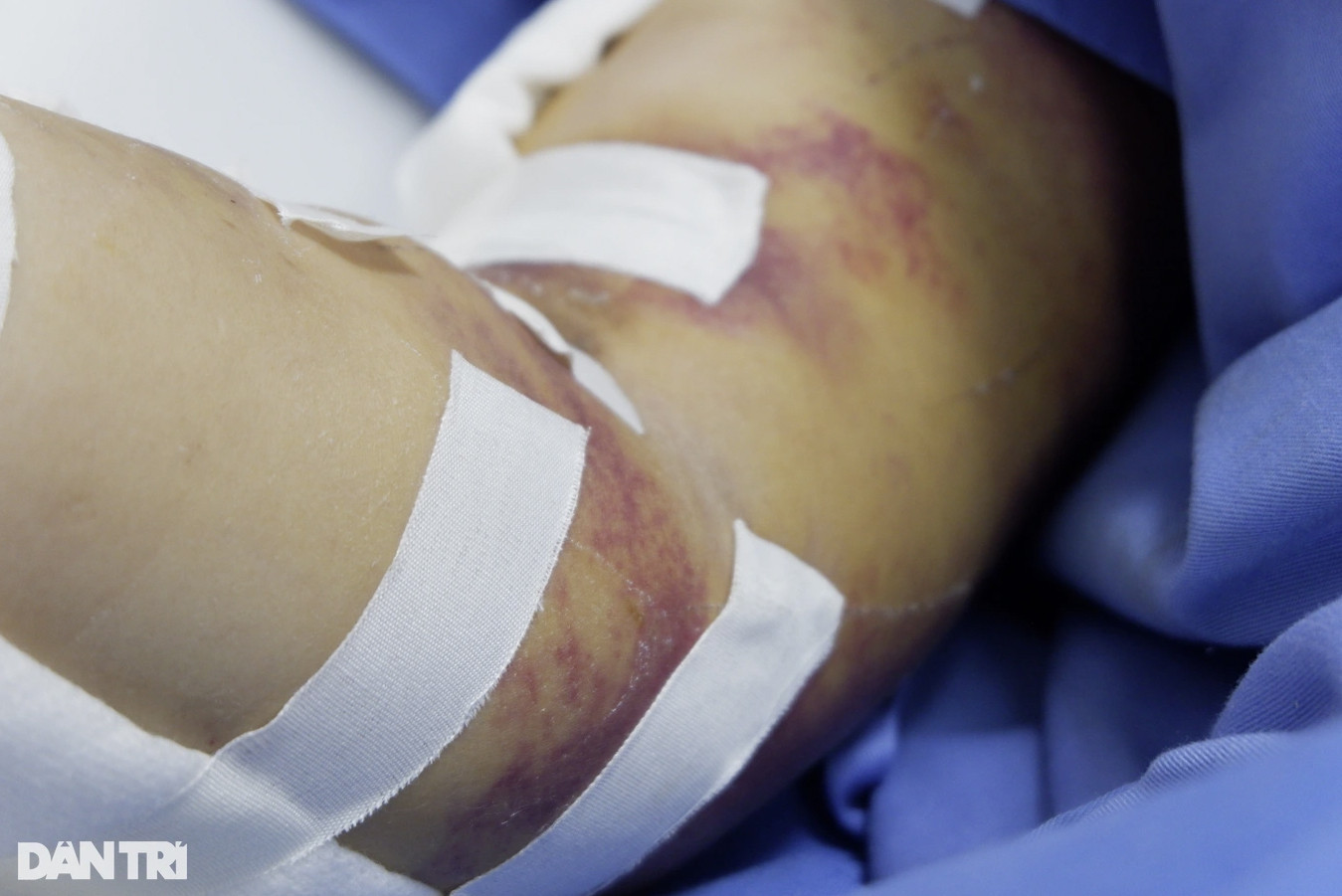Tay phải của bệnh nhân bị chấn thương nặng sau cú nhảy (Ảnh: Minh Nhật).